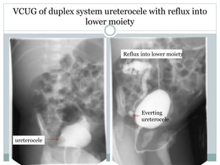VCUG of duplex system ureterocele with reflux into
lower moiety
ureterocele
Reflux into lower moiety
Everting
ureterocele
 