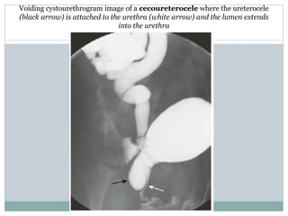 Voiding cystourethrogram image of a cecoureterocele where the ureterocele
(black arrow) is attached to the urethra (white arrow) and the lumen extends
into the urethra
 