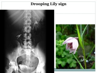 Drooping Lily sign
 