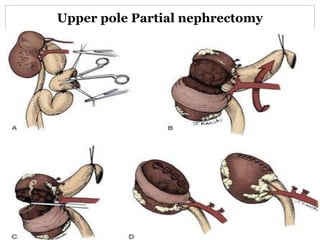 Upper pole Partial nephrectomy
 