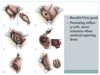  Results:Very good.
 Persisting reflux-
5-10%, more
common when
ureteral tapering
done.
 