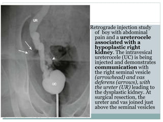 Retrograde injection study
of boy with abdominal
pain and a ureterocele
associated with a
hypoplastic right
kidney. The intravesical
ureterocele (UC) is being
injected and demonstrates
communication with
the right seminal vesicle
(arrowhead) and vas
deferens (arrows), with
the ureter (UR) leading to
the dysplastic kidney. At
surgical resection, the
ureter and vas joined just
above the seminal vesicles
 