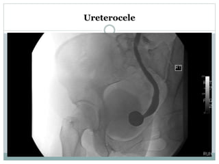 VCUG of ureterocele
Early filling phase
 