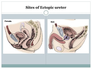Sites of Ectopic ureter
 