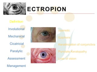 ECTROPION
 Definition

Involutional          cosmetic

Mechanical            Epiphora

 Cicatricial          Keratinization of conjunctiva

 Paralytic            Punctate Keratopathy

Assessment            Loss of vision

Management
 