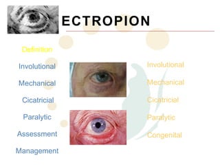 ECTROPION
 Definition

Involutional           Involutional

Mechanical             Mechanical

 Cicatricial           Cicatricial

 Paralytic             Paralytic

Assessment             Congenital

Management
 