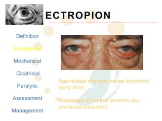 ECTROPION
 Definition

Involutional

Mechanical

 Cicatricial
                Age-related changes cause horizontal
 Paralytic      laxity of lid
Assessment      Weakness of canthal tendons and
                pre-tarsal orbicularis
Management
 