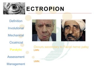 ECTROPION
 Definition

Involutional

Mechanical

 Cicatricial
                Occurs secondary to Facial nerve palsy
 Paralytic      LMN:   Bell’s palsy
                       Ramsey-Hunt Syndrome (Herpes Zoster)
                       Parotid tumour or infiltration
Assessment             Cerebello-pontine angle lesion
                UMN:   Stroke/AVM
Management             Tumours
                       Infection
 