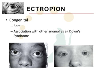 ECTROPION
• Congenital
  – Rare
  – Association with other anomalies eg Down’s
    Syndrome
 