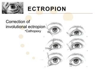 ECTROPION

Correction of
involutional ectropion
          •Cathopexy
 