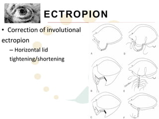 ECTROPION
• Correction of involutional
ectropion
  – Horizontal lid
  tightening/shortening
 