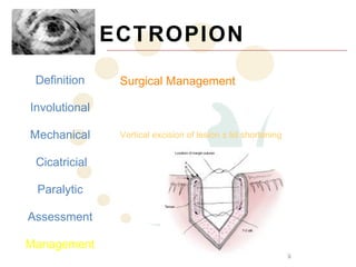 ECTROPION
 Definition     Surgical Management

Involutional
                Mechanical
Mechanical      Vertical excision of lesion ± lid shortening


 Cicatricial

 Paralytic

Assessment

Management
 