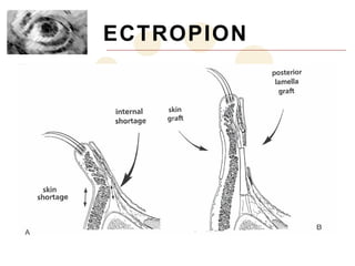 ECTROPION
 
