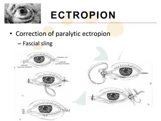 ECTROPION
• Correction of paralytic ectropion
  – Fascial sling
 