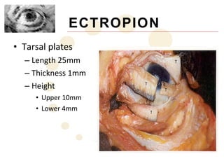ECTROPION
• Tarsal plates
  – Length 25mm
  – Thickness 1mm
  – Height
     • Upper 10mm
     • Lower 4mm
 