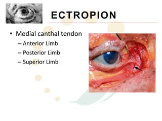 ECTROPION
• Medial canthal tendon
  – Anterior Limb
  – Posterior Limb
  – Superior Limb
 
