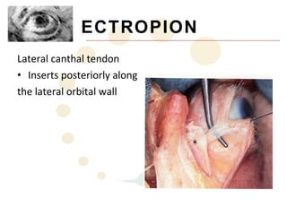 ECTROPION
Lateral canthal tendon
• Inserts posteriorly along
the lateral orbital wall
 