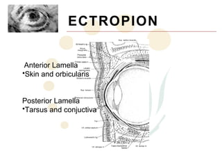 ECTROPION


 Anterior Lamella
•Skin and orbicularis


Posterior Lamella
•Tarsus and conjuctiva
 