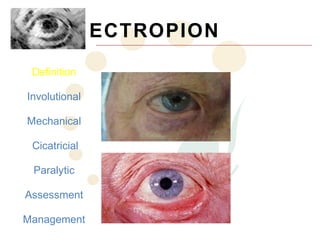 ECTROPION
 Definition

Involutional

Mechanical

 Cicatricial

 Paralytic

Assessment

Management
 