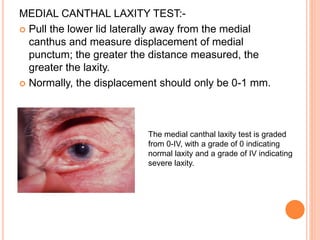 MEDIAL CANTHAL LAXITY TEST:-
 Pull the lower lid laterally away from the medial
canthus and measure displacement of medial
punctum; the greater the distance measured, the
greater the laxity.
 Normally, the displacement should only be 0-1 mm.
The medial canthal laxity test is graded
from 0-IV, with a grade of 0 indicating
normal laxity and a grade of IV indicating
severe laxity.
 