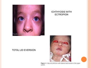 ICHTHYOSIS WITH
ECTROPION
TOTAL LID EVERSION
 