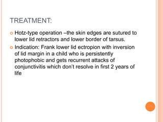 TREATMENT:
 Hotz-type operation –the skin edges are sutured to
lower lid retractors and lower border of tarsus.
 Indication: Frank lower lid ectropion with inversion
of lid margin in a child who is persistently
photophobic and gets recurrent attacks of
conjunctivitis which don’t resolve in first 2 years of
life
 