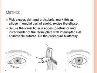 METHOD
 Pick excess skin and orbicularis, mark this as
ellipse in medial part of eyelid, excise the ellipse.
 Suture the lower lid skin edges to retractor and
lower border of the tarsal plate with interrupted 6-0
absorbable sutures. Do the procedure bilaterally
 
