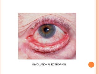 INVOLUTIONAL ECTROPION
 