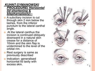 KUHNT-SYMANOWSKI
PROCEDURE( Horizontal
lid shortening &
blepharoplasty):-
 A subciliary incision is cut
through skin 2 mm below the
lashes, from the inferior
punctum to the lateral canthal
angle.
 At the lateral canthus the
incision is continued obliquely
downward in a natural skin
crease for a distance of
10mm and the skin flap is
undermined to the level of the
orbital rim.
 Rest surgery is same as
previously described
 Indication- generalised
horizontal lid laxity with
excess skin.
 