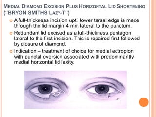 MEDIAL DIAMOND EXCISION PLUS HORIZONTAL LID SHORTENING
(“BRYON SMITHS LAZY-T”)
 A full-thickness incision uptil lower tarsal edge is made
through the lid margin 4 mm lateral to the punctum.
 Redundant lid excised as a full-thickness pentagon
lateral to the first incision. This is repaired first followed
by closure of diamond.
 Indication – treatment of choice for medial ectropion
with punctal eversion associated with predominantly
medial horizontal lid laxity.
 
