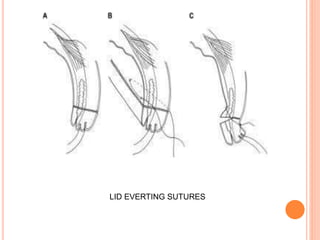 LID EVERTING SUTURES
 