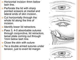  Horizontal incision 4mm below
lash line.
 Perforate the lid with sharp
pointed scissors at medial and
lateral ends of skin incision.
 Cut horizontally through the
whole lid along the line of
incision.
 Identify lower lid retractors.
 Pass 3, 4-0 absorbable sutures
through conjunctiva, lid retractors,
tarsal plate coming out through
1mm below lash line.
 Close the skin with suture
 Tie a double armed sutures under
tension, just to evert lid margin
 