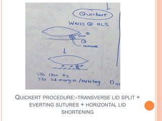 QUICKERT PROCEDURE:-TRANSVERSE LID SPLIT +
EVERTING SUTURES + HORIZONTAL LID
SHORTENING
 