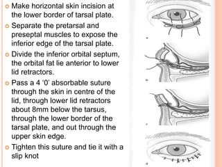  Make horizontal skin incision at
the lower border of tarsal plate.
 Separate the pretarsal and
preseptal muscles to expose the
inferior edge of the tarsal plate.
 Divide the inferior orbital septum,
the orbital fat lie anterior to lower
lid retractors.
 Pass a 4 ‘0’ absorbable suture
through the skin in centre of the
lid, through lower lid retractors
about 8mm below the tarsus,
through the lower border of the
tarsal plate, and out through the
upper skin edge.
 Tighten this suture and tie it with a
slip knot
 