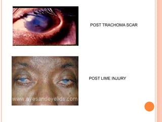 POST TRACHOMA SCAR
POST LIME INJURY
 
