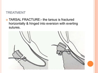 TREATMENT
 TARSAL FRACTURE:- the tarsus is fractured
horizontally & hinged into eversion with everting
sutures.
 
