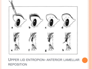 UPPER LID ENTROPION- ANTERIOR LAMELLAR
REPOSITION
 