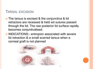 TARSAL EXCISION
 The tarsus is excised & the conjunctiva & lid
retractors are recessed & held wit sutures passed
through the lid. The raw posterior lid surface rapidly
becomes conjuntivalised.
 INDICATIONS:- entropion associated with severe
lid retraction & a small scarred tarsus when a
corneal graft is not planned
 
