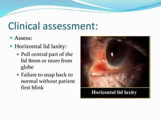 Clinical assessment:
 Assess:
 Horizontal lid laxity:
 Pull central part of the
lid 8mm or more from
globe
 Failure to snap back to
normal without patient
first blink
 