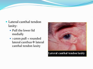  Lateral canthal tendon
laxity:
 Pull the lower lid
medially
 >2mm pull + rounded
lateral canthus lateral
canthal tendon laxity
 
