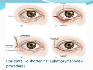 Horizontal lid shortening (Kuhnt-Szymanowski
procedure)
 