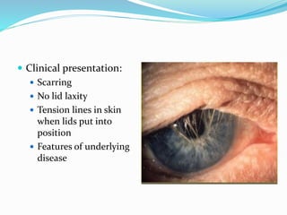  Clinical presentation:
 Scarring
 No lid laxity
 Tension lines in skin
when lids put into
position
 Features of underlying
disease
 