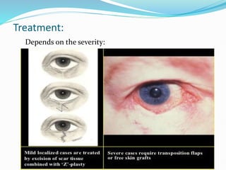 Treatment:
Depends on the severity:
 