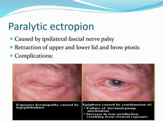 Paralytic ectropion
 Caused by ipsilateral fascial nerve palsy
 Retraction of upper and lower lid and brow ptosis
 Complications:
 