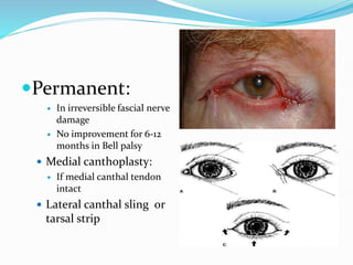 Permanent:
 In irreversible fascial nerve
damage
 No improvement for 6-12
months in Bell palsy
 Medial canthoplasty:
 If medial canthal tendon
intact
 Lateral canthal sling or
tarsal strip
 