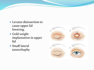  Levator disinsertion to
cause upper lid
lowering.
 Gold weight
implantation in upper
lid
 Small lateral
tarsorrhaphy
 