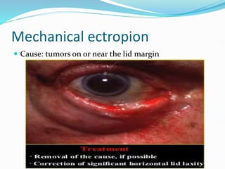 Mechanical ectropion
 Cause: tumors on or near the lid margin
 
