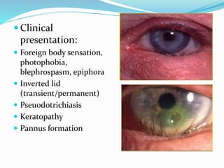  Clinical
presentation:
 Foreign body sensation,
photophobia,
blephrospasm, epiphora
 Inverted lid
(transient/permanent)
 Pseuodotrichiasis
 Keratopathy
 Pannus formation
 