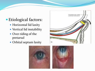 Etiological factors:
 Horizontal lid laxity
 Vertical lid instability
 Over riding of the
pretarsal
 Orbital septum laxity
 