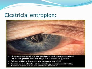 Cicatricial entropion:
 